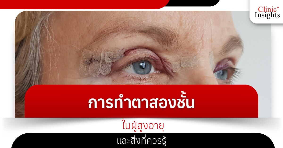 Double eyelid surgery for the elderly and what you should know