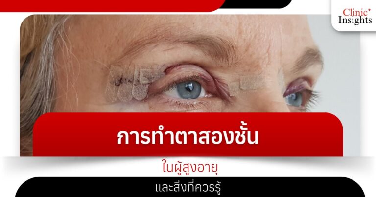 Double eyelid surgery for the elderly and what you should know