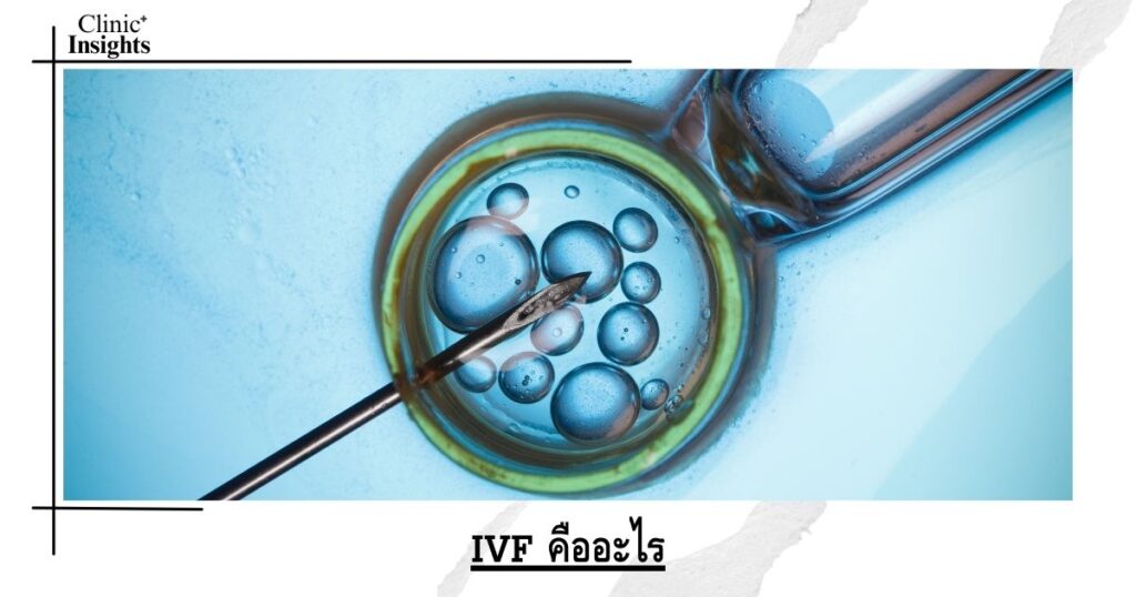 What is IVF?