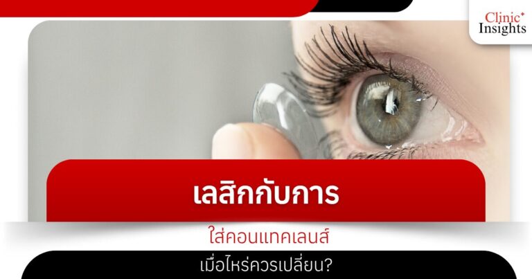 LASIK and contact lens wear when should you change