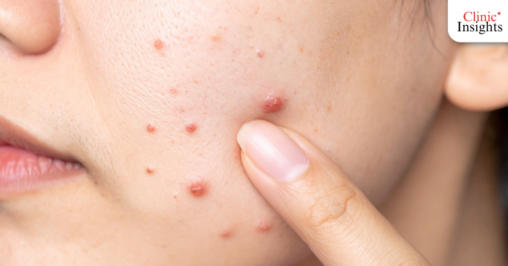 สิวหัวช้างและสิวซีสต์ (Nodule & Cyst)