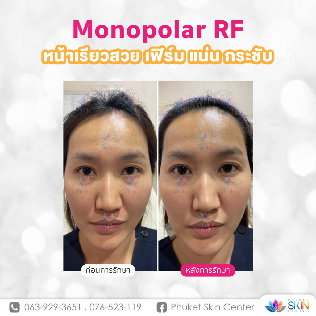 ยกกระชับใบหน้า