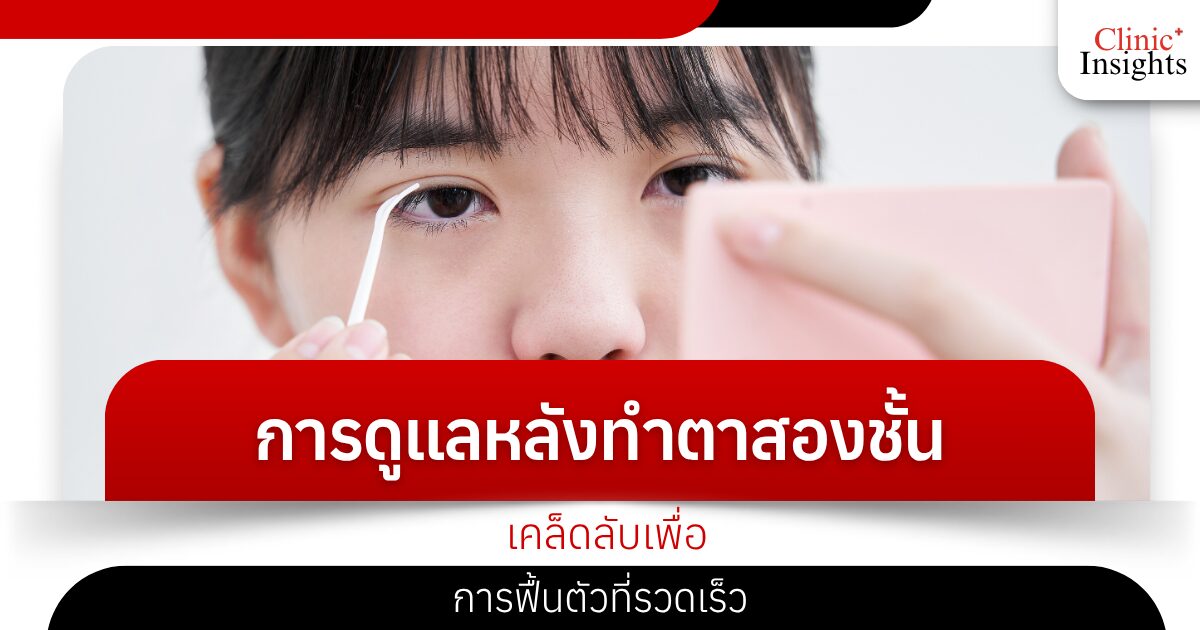 Post-Eyelid Care Tips for a Fast Recovery