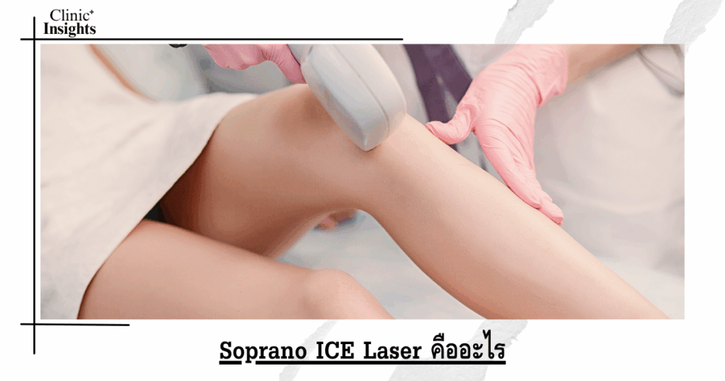 What is Soprano ICE Laser?