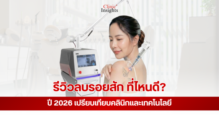Tattoo removal review 2026 (1)