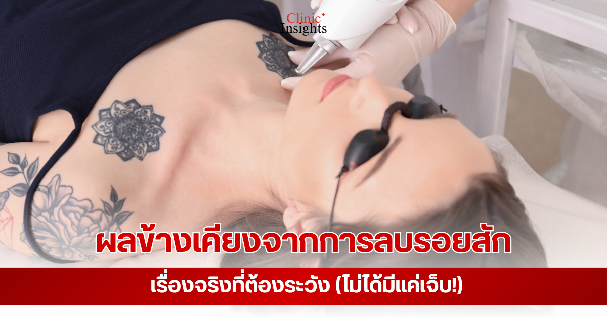 ผลข้างเคียงจากการลบรอยสัก เรื่องจริงที่ต้องระวัง (ไม่ได้มีแค่เจ็บ!)