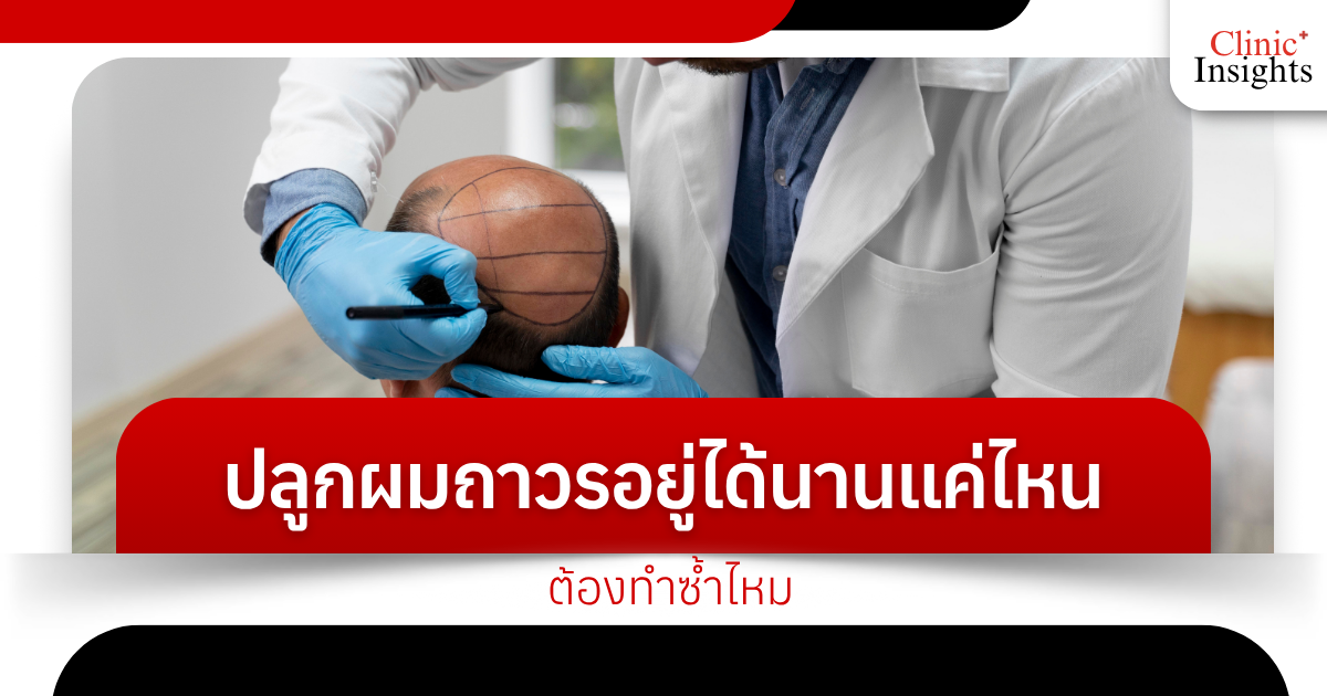 How long does a permanent hair transplant last? Do I need to repeat it?