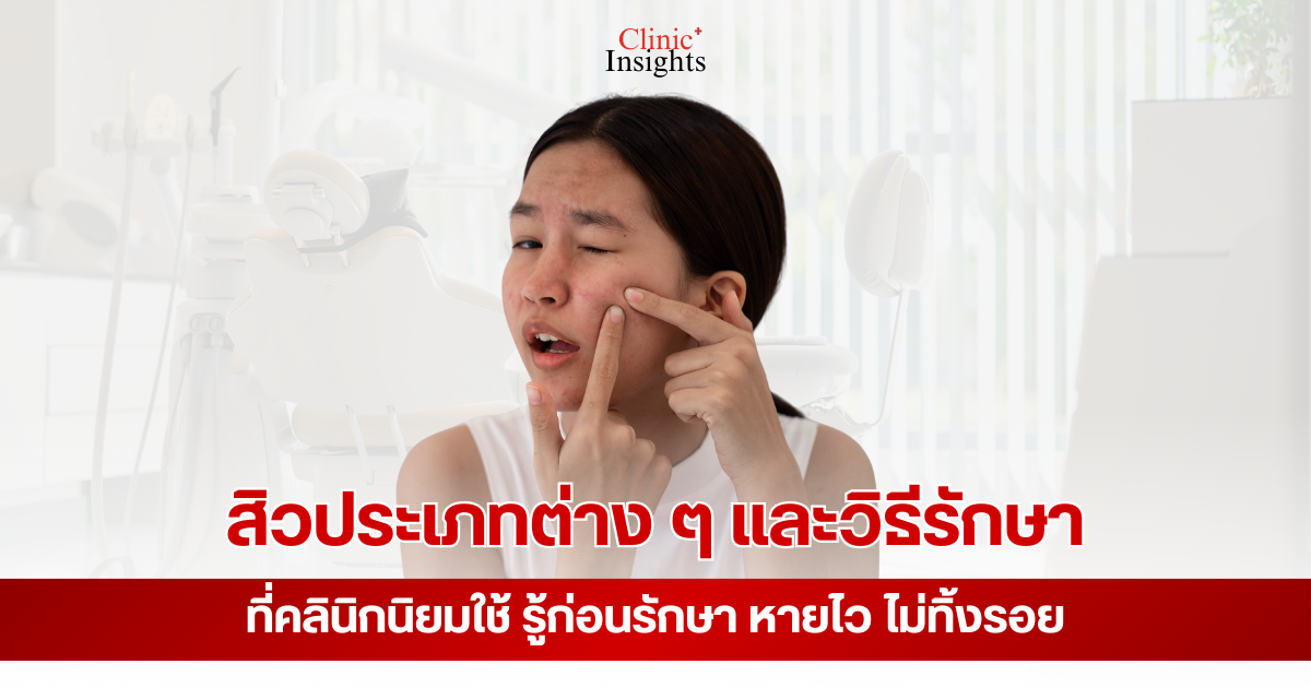 สิวประเภทต่าง ๆ และวิธีรักษาที่คลินิกนิยมใช้ รู้ก่อนรักษา หายไว ไม่ทิ้งรอย