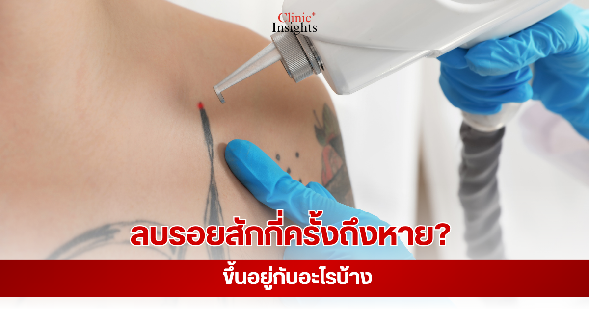 ลบรอยสักกี่ครั้งถึงหาย ขึ้นอยู่กับอะไรบ้าง