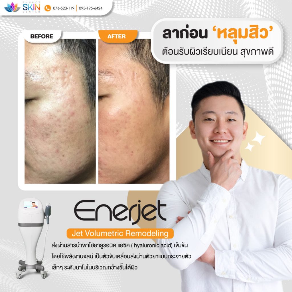 phuketskincenter-เลเซอร์หลุมสิว