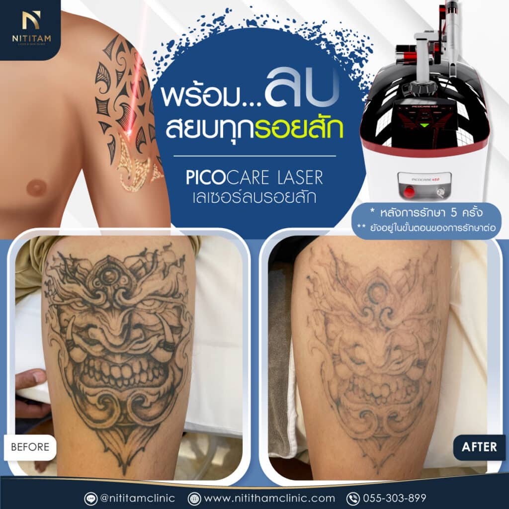 laser-nitithamclinic