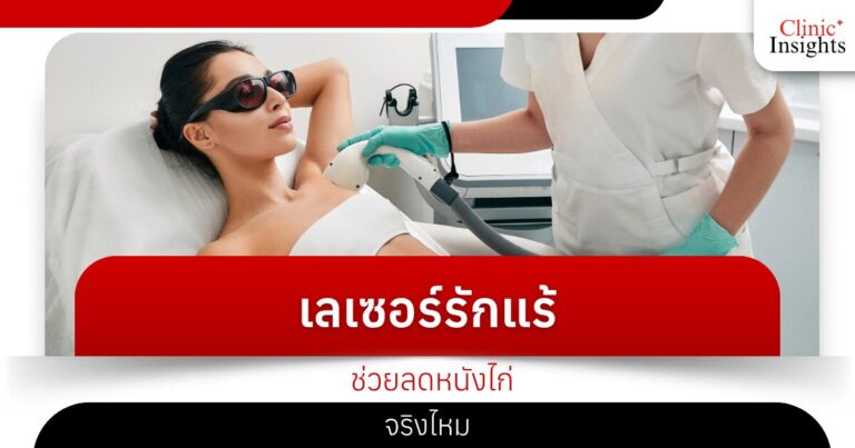 เลเซอร์รักแร้ช่วยลดหนังไก่จริงไหม