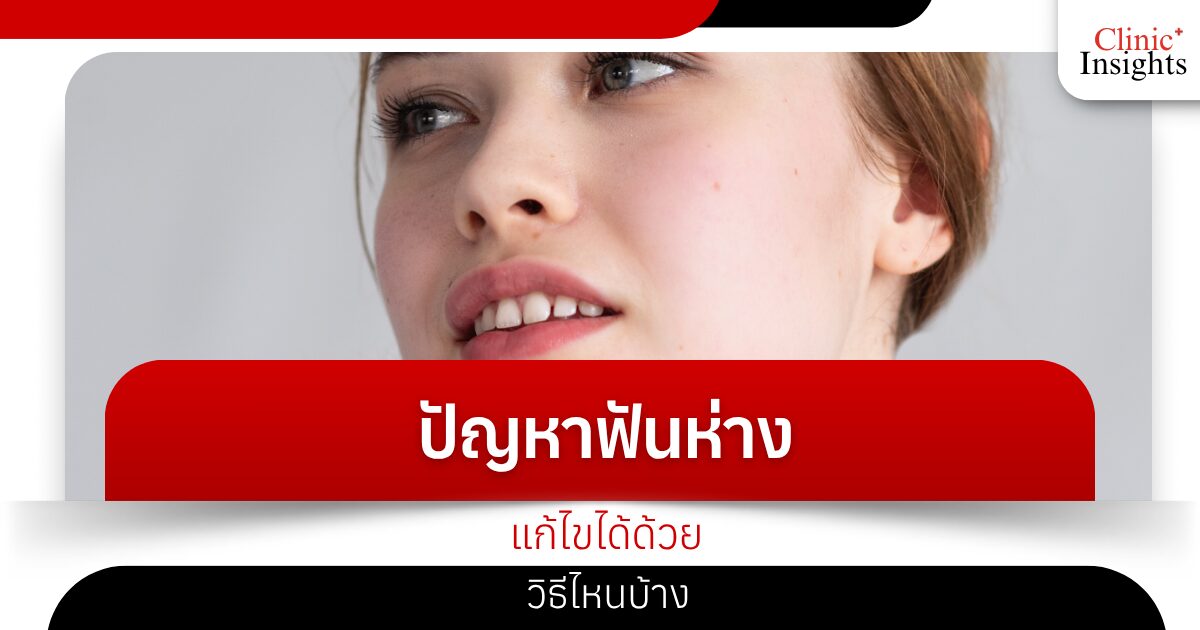 ปัญหาฟันห่าง แก้ไขได้ด้วยวิธีไหนบ้าง​