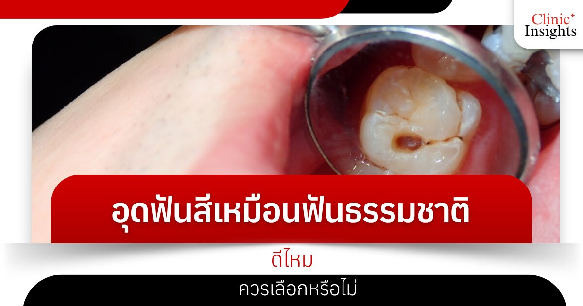 อุดฟันสีเหมือนฟันธรรมชาติ ดีไหม ควรเลือกหรือไม่​