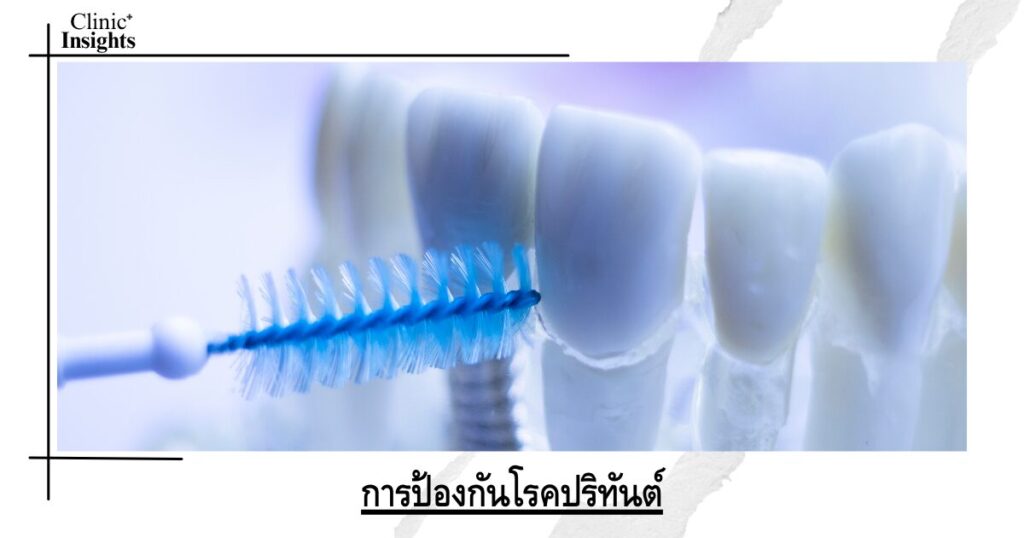 การป้องกันโรคปริทันต์
