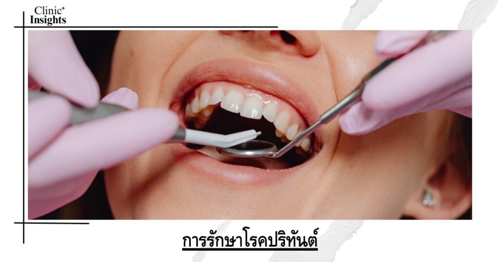 การรักษาโรคปริทันต์