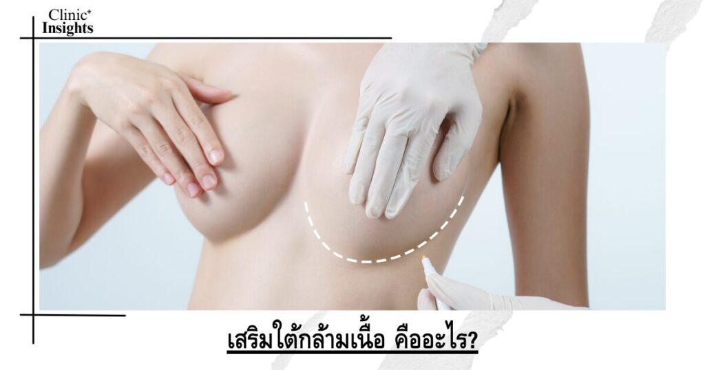 เสริมใต้กล้ามเนื้อ คืออะไร