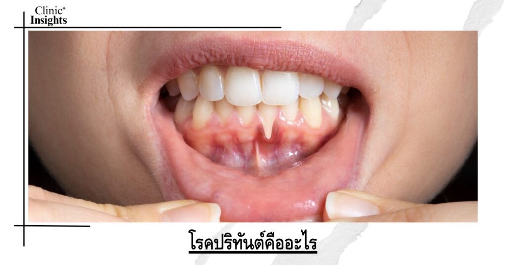 โรคปริทันต์คืออะไร