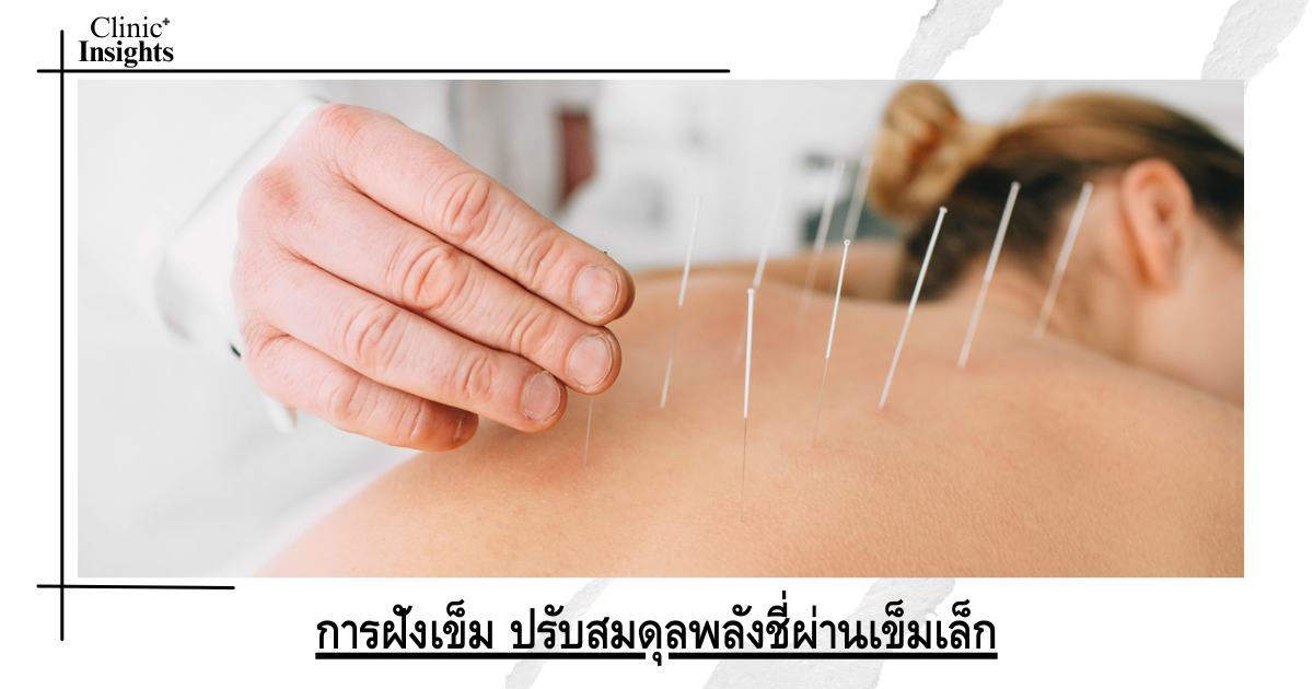 Acupuncture: Balancing Chi Energy through Fine Needles