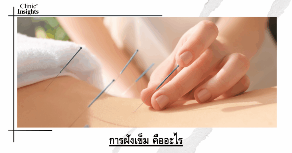 What is acupuncture?