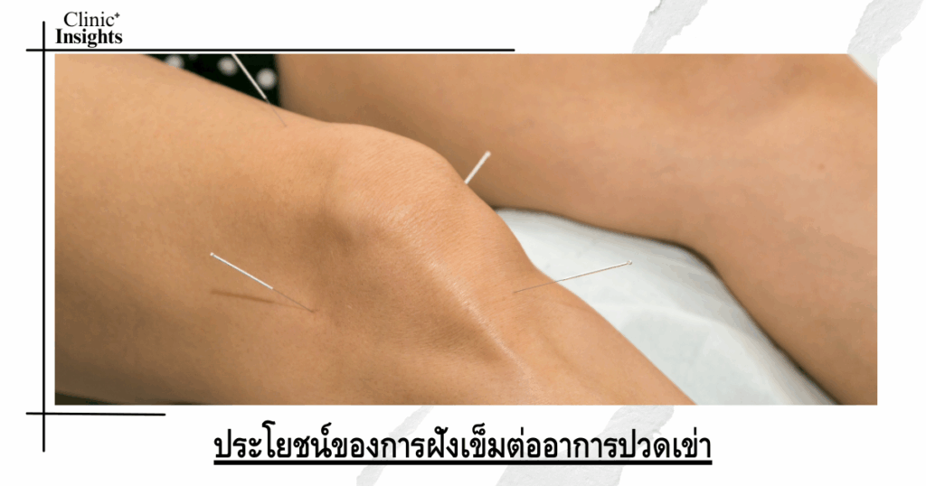 Benefits of acupuncture for knee pain