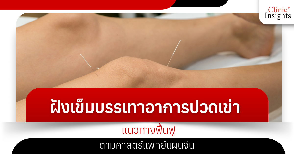Acupuncture for knee pain relief, a rehabilitation approach based on traditional Chinese medicine.