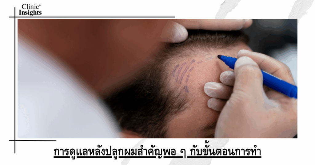 Post-hair transplant care is just as important as the procedure itself.