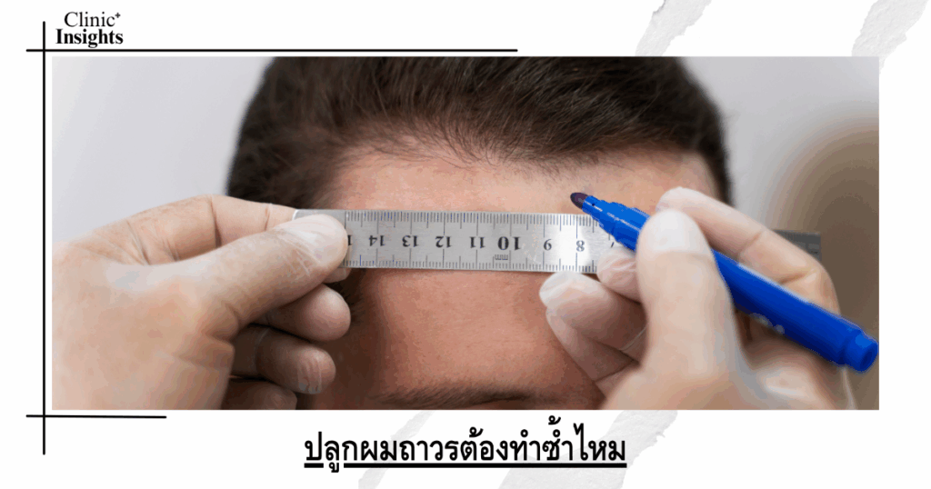 Do I need to repeat the permanent hair transplant?