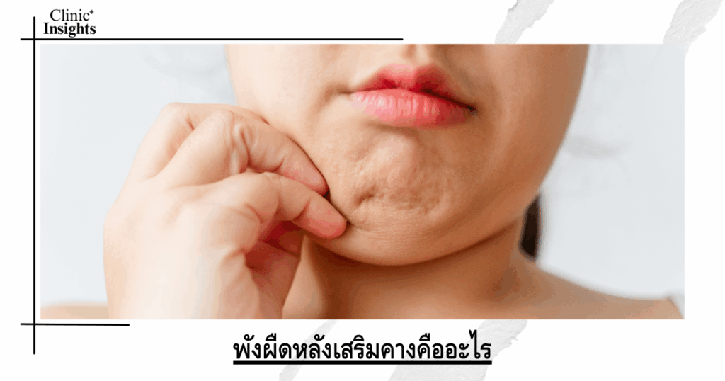 What is post-chin augmentation fibrosis?