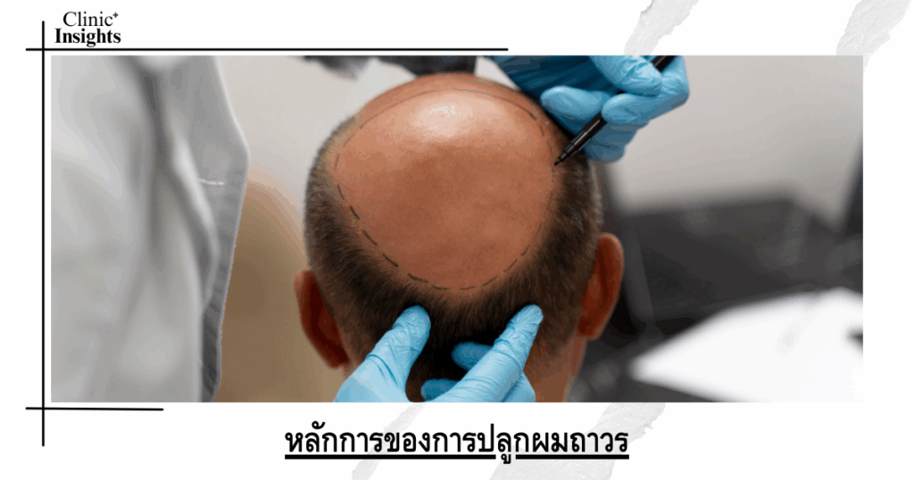 Principles of permanent hair transplantation