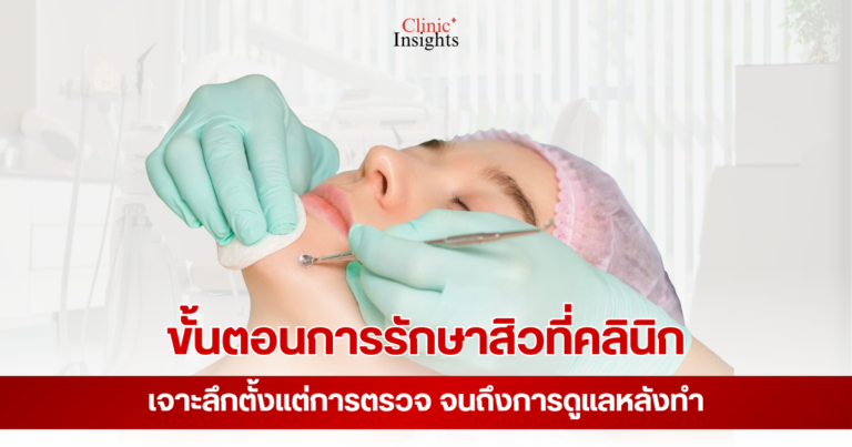 ขั้นตอนการรักษาสิวที่คลินิก เจาะลึกตั้งแต่การตรวจ จนถึงการดูแลหลังทำ
