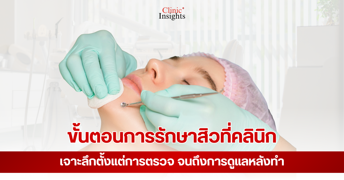 ขั้นตอนการรักษาสิวที่คลินิก เจาะลึกตั้งแต่การตรวจ จนถึงการดูแลหลังทำ