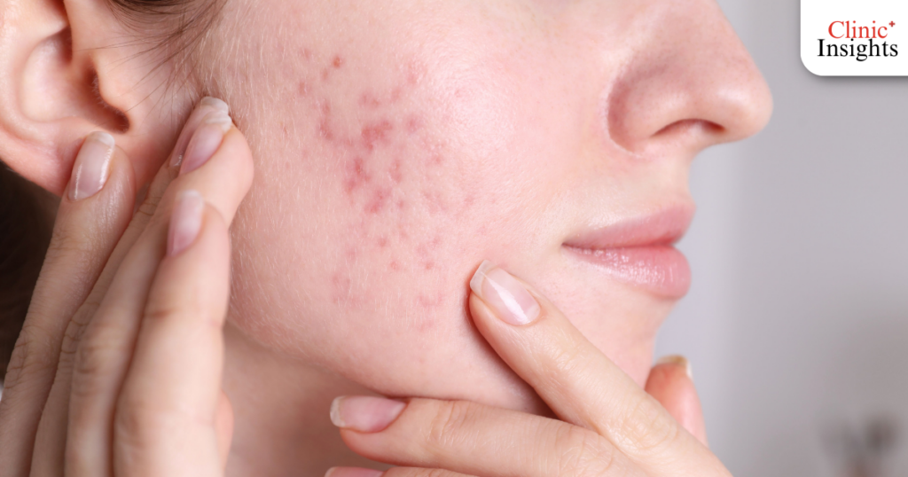 ข้อดีของการรักษาสิวที่คลินิก