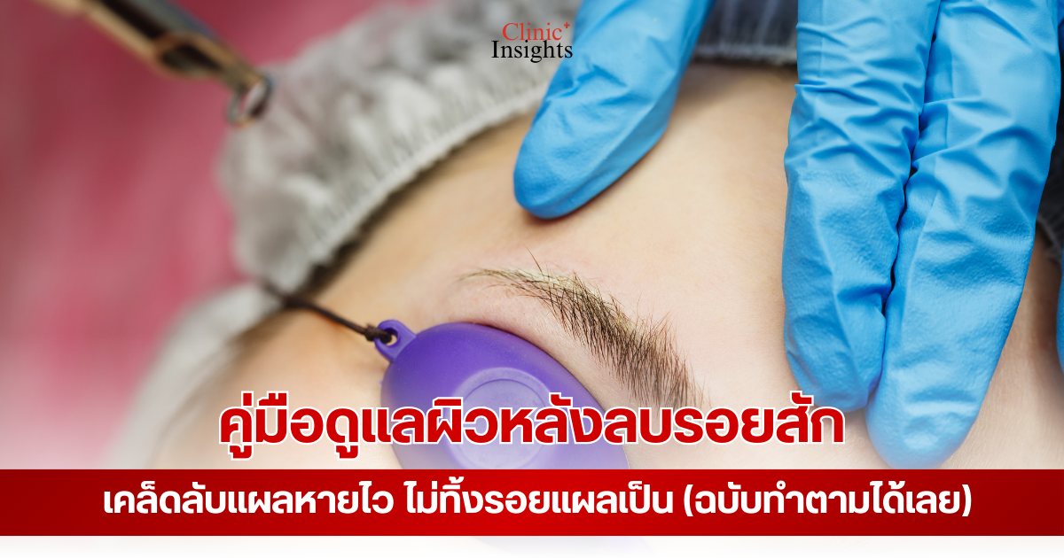 คู่มือดูแลผิวหลังลบรอยสัก เคล็ดลับแผลหายไว ไม่ทิ้งรอยแผลเป็น (ฉบับทำตามได้เลย)