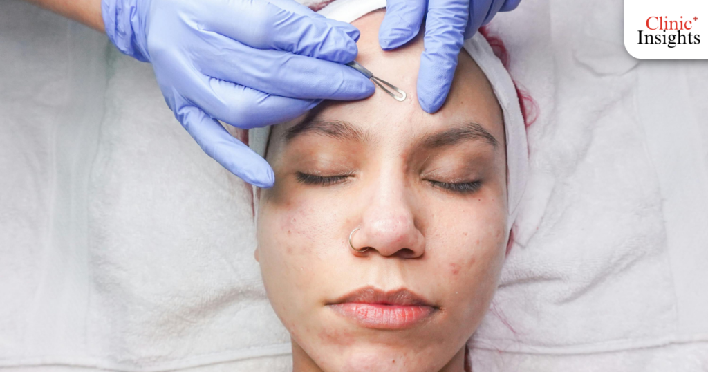 ประมาณการราคาค่าบริการรักษาสิว