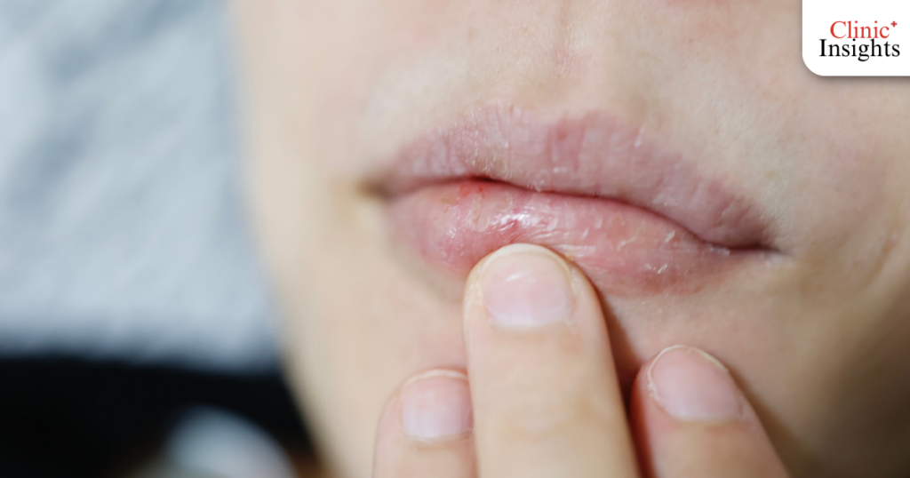 ปากแห้ง ตาแห้ง (จากยากิน)