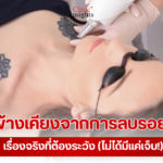 ผลข้างเคียงจากการลบรอยสัก เรื่องจริงที่ต้องระวัง (ไม่ได้มีแค่เจ็บ!)