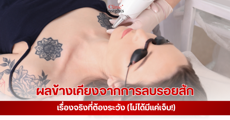 ผลข้างเคียงจากการลบรอยสัก เรื่องจริงที่ต้องระวัง (ไม่ได้มีแค่เจ็บ!)