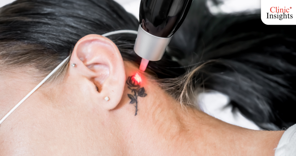 ลบรอยสัก คืออะไร? (The Mechanism)