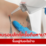 ลบรอยสักกี่ครั้งถึงหาย ขึ้นอยู่กับอะไรบ้าง