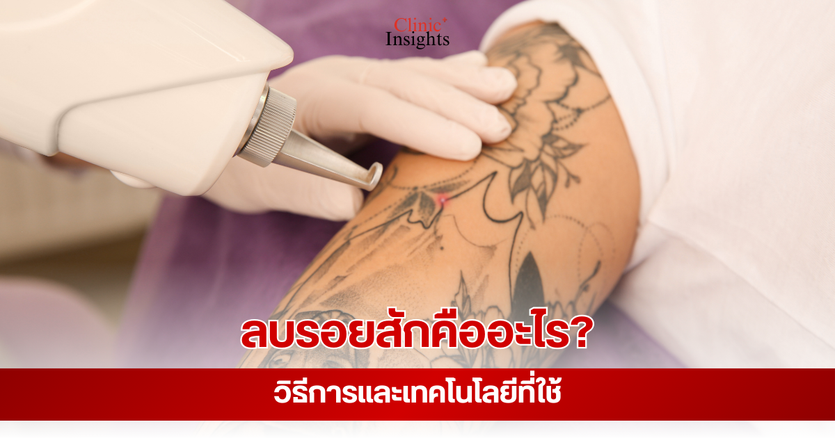 ลบรอยสักคืออะไร วิธีการและเทคโนโลยีที่ใช้