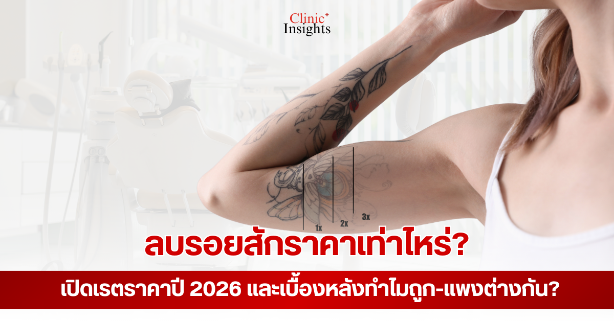 ลบรอยสักราคาเท่าไหร่ เปิดเรตราคาปี 2026 และเบื้องหลังทำไมถูก-แพงต่างกัน