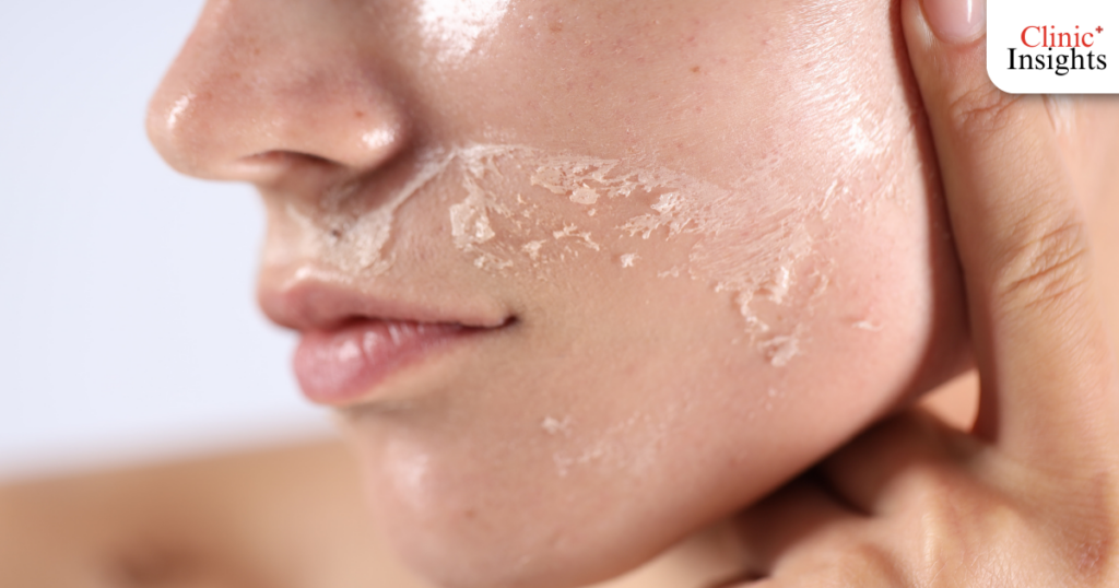 อาการระคายเคืองและผิวแห้งลอก (Dryness & Peeling)