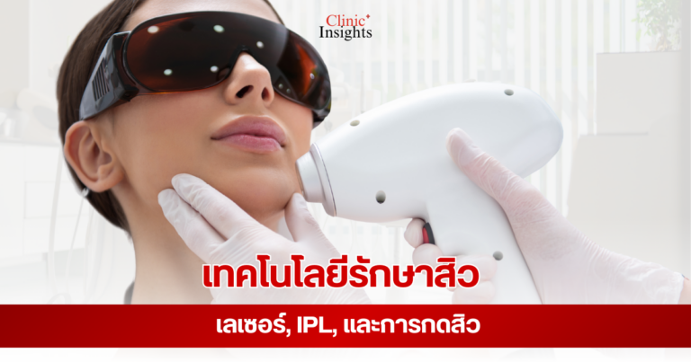 เทคโนโลยีรักษาสิว เลเซอร์, IPL, และการกดสิว