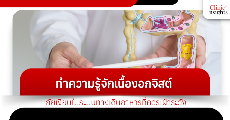 ทำความรู้จักเนื้องอกจิสต์ ภัยเงียบในระบบทางเดินอาหารที่ควรเฝ้าระวัง