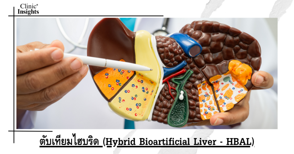 ตับเทียมไฮบริด (Hybrid Bioartificial Liver - HBAL)